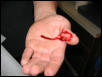 Snake bite